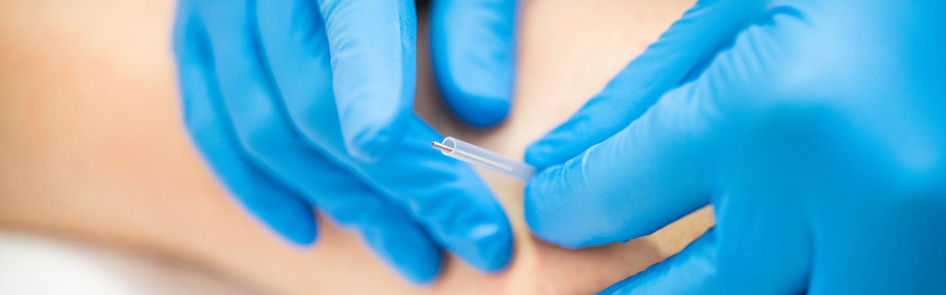 Dry Needling bij - KernGezond Lelystad, Mijdrecht en Zeist