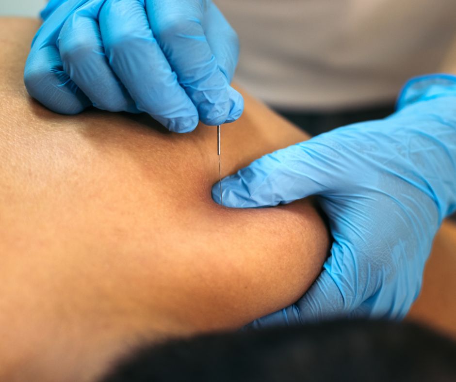 Dry needling bij - KernGezond